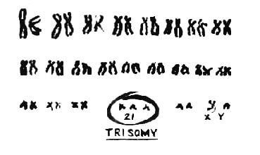 [Image: Down Syndrome chromosomes 2.jpg]